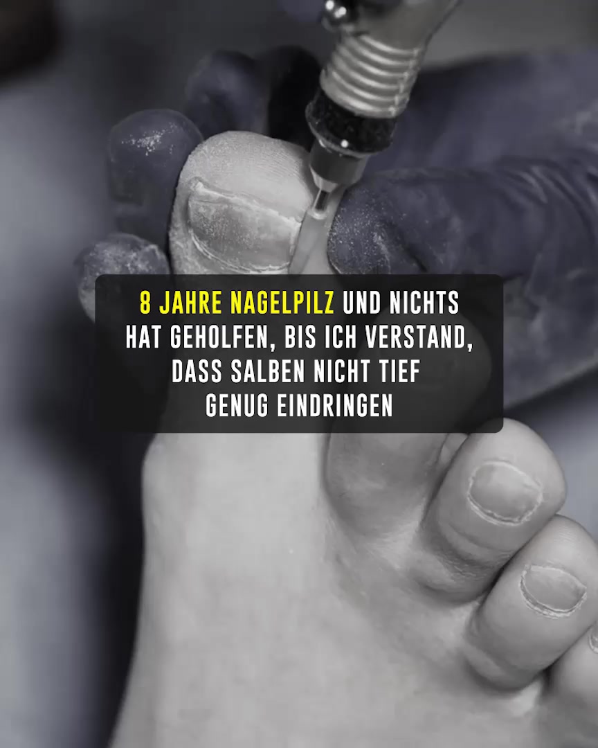 Nagelpilz endgültig loswerden…